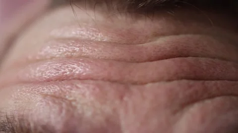 Macro closeup of deep forehead wrinkles Video stock 329586236