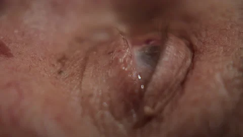 Macro, a drop of helium solution falls into the eye of an elderly man after Stock-Footage 344754234