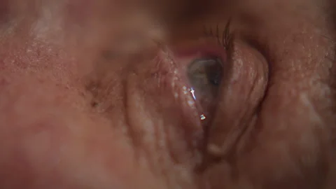 Macro, a drop of medication falls into the eye of an elderly man after lens Stock-Footage 344754317