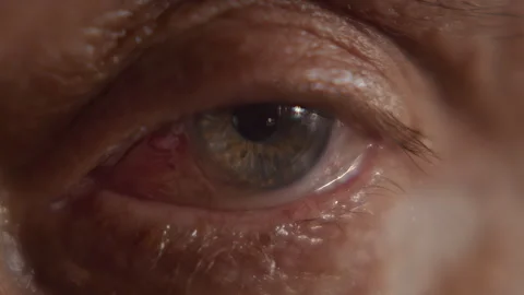 Macro, eye of elderly man after lens replacement surgery of the eye looks Stock-Footage 344754393