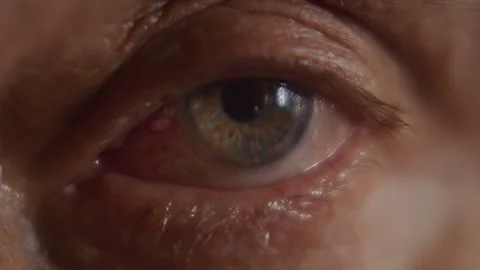 Macro, eye of an elderly man after lens replacement surgery during Stock-Footage 344754508