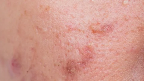 Macro of face with skin problems and acne. 스톡 동영상 112378521