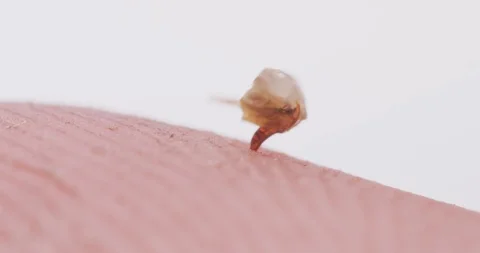 MACRO | Finger with honey bee sting pomping venom Stock Footage 89634083