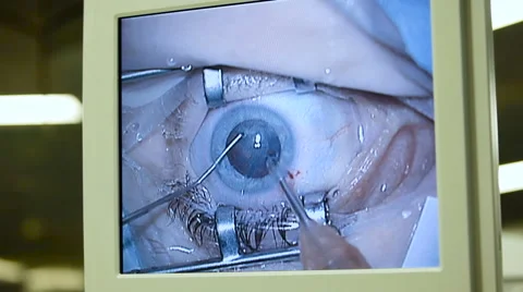 Macro Image of Eyes on Displays During Eye Surgery With Using Medical Tools. Video stock 62510859