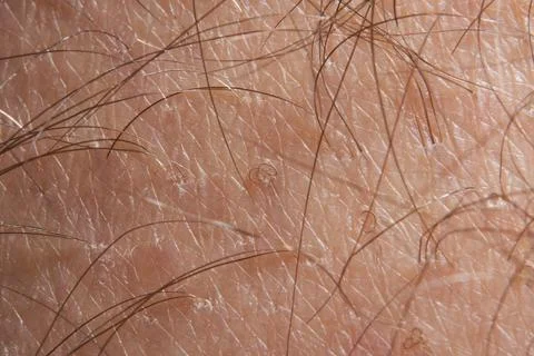 Macro ingrown hair microscope Stock Photos
