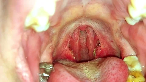 Macro opened his mouth with a throat tonsil. follicular sore throat, purule.. Stock Footage 252884197