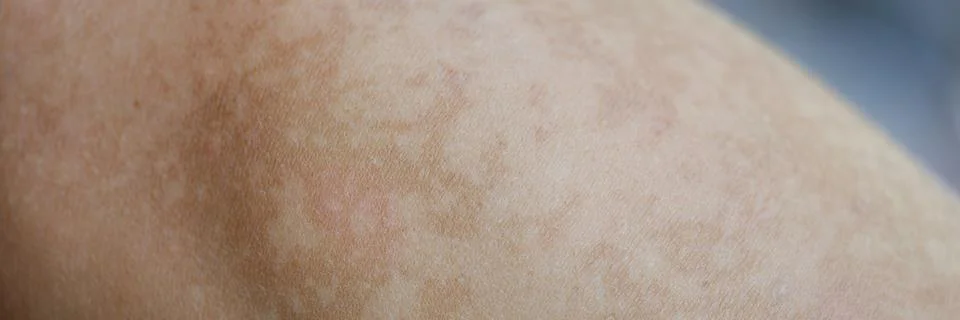Macro part of the body is uneven pigmentation skin Stock Photos