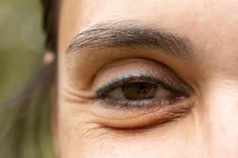 Macro of puffy eye causing eye bags Photos