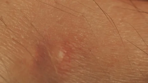 Macro of pustule acne. Fingers touch skin next to the pimple zit on hand. Body Stock Footage 124213558