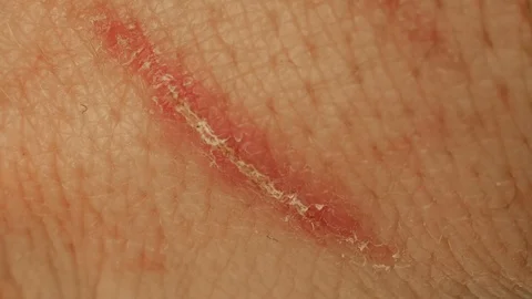 Macro of scrape, dried wound. Closeup healed scratch with a crust, injury. Skin 스톡 동영상 125691289
