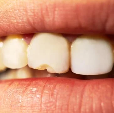 Macro shot of the broken tooth. Stock Photos