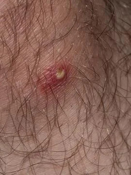 Macro shot capturing a pustule on human skin, nestled among hairs, vividly .. 스톡 사진