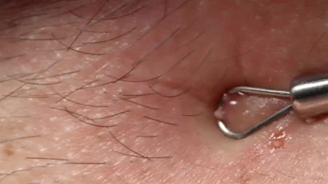 Macro shot of comedone extractor tool popping a pimple on skin 스톡 동영상 337148473