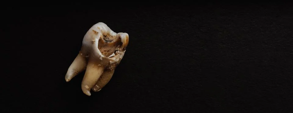 Macro shot of a decayed teeth till root after extraction of dentist. Stock Photos