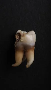 Macro shot of a decayed teeth till root after extraction of dentist. Stock Photos