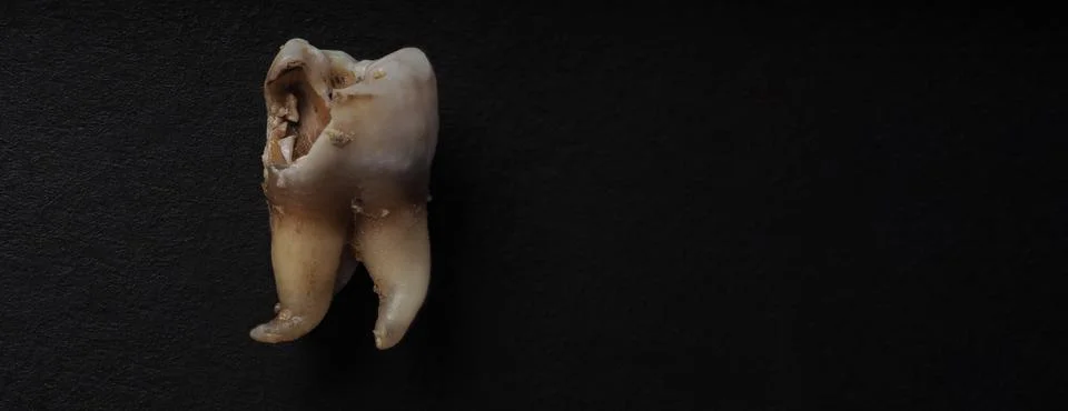 Macro shot of a decayed teeth till root after extraction of dentist. Stock Photos