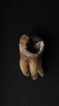 Macro shot of a decayed teeth till root after extraction of dentist. Stock Photos