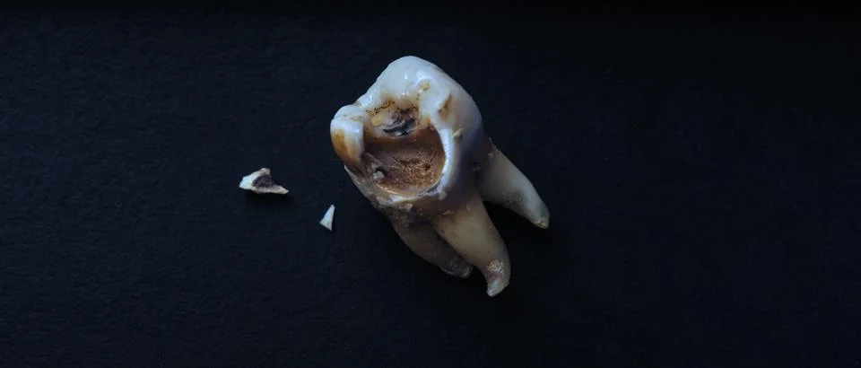 Macro shot of a decayed teeth till root after extraction of dentist. Stock Photos