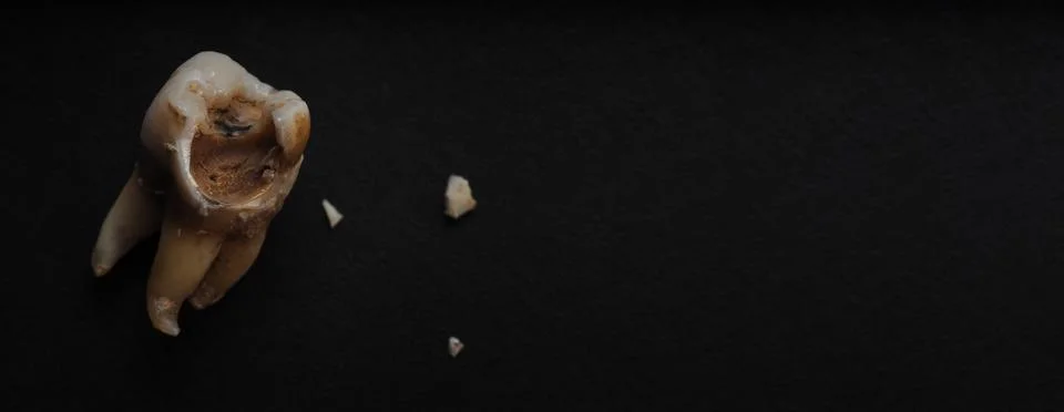 Macro shot of a decayed teeth till root after extraction of dentist. Stock Photos