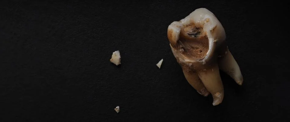 Macro shot of a decayed teeth till root after extraction of dentist. Stock Photos