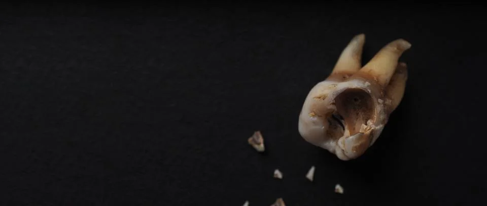 Macro shot of a decayed teeth till root after extraction of dentist. Stock Photos