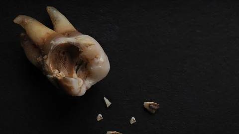 Macro shot of a decayed teeth till root after extraction of dentist. Stock Photos