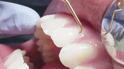 Macro Shot Dentist Working on Patient's Teeth Stock Footage 168368302