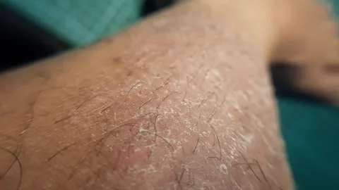 Macro shot of dry scaly skin and peeling epidermis on a human leg Stock Footage 341373151