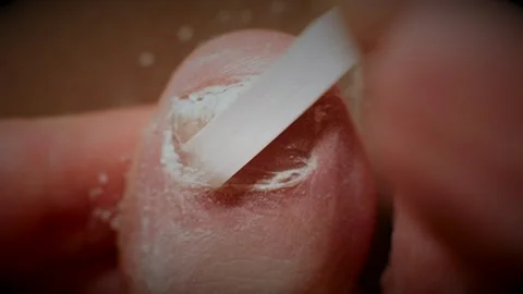 Macro shot of filing on big toe nail with fungal infection, creating Video stock 268931063
