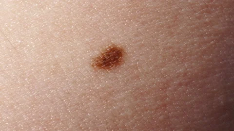 Macro shot of mole on human skin. Stock Footage 155332205