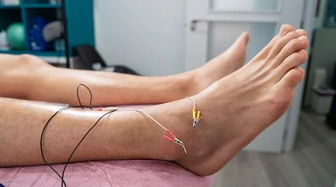 Macro shot of needles with electricity inside the ankle. patient with spraine Stock Photos