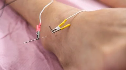 Macro shot of needles with electricity inside the ankle. patient with spraine Stock Photos