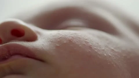 Macro shot of a sleeping childs face affected by diathesis. Troubled face ski Stock Footage 166178930