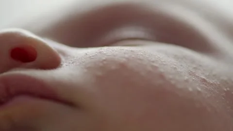 Macro shot of a sleeping childs face affected by diathesis. Troubled face s.. Stock Footage 254652338