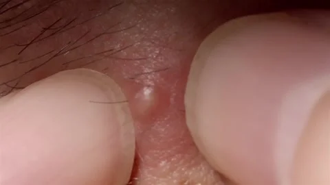 Macro shot of squeezing a pimple on human skin close up 스톡 동영상 337148441