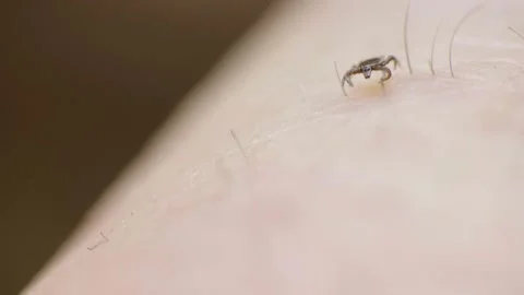 Macro video of crawling mite on human's skin. Dangerous tick on the skin crawls Stock Footage 156504267