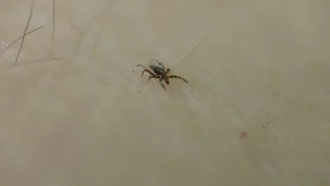 Macro video of crawling mite on human's skin. Dangerous tick on the skin crawls Stock Footage 156512425