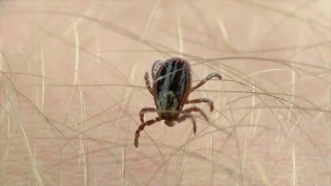 Macro Video of Encephalitis Tick Insect Crawling on Human Skin. Stock Footage 140523006