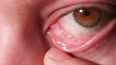 gross eye infection