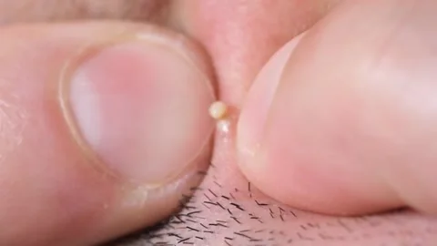 Macro video, squeezing a white pimple from the face. Vídeos de archivo 217764347
