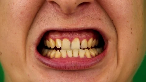 Macro video of yellow teeth. A close-up of a tooth, struck by caries. The concep Stock Footage 92860110