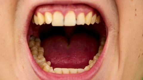 Macro video of yellow teeth. A close-up of a tooth, struck by caries. The concep Stock Footage 92860139