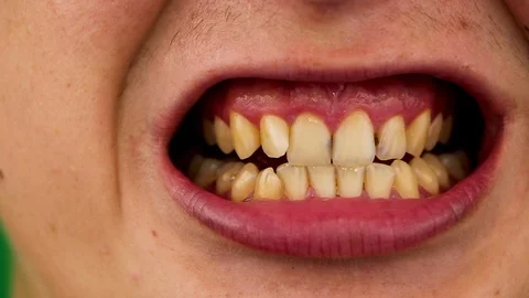 Macro video of yellow teeth. A close-up of a tooth, struck by caries. The concep Stock Footage 92860164