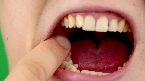Macro video of yellow teeth. A close-up of a tooth, struck by caries. The concep Stock Footage 92860188