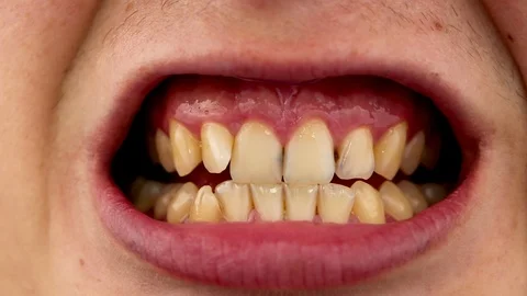Macro video of yellow teeth. A close-up of a tooth, struck by caries. The concep Stock Footage 92860255