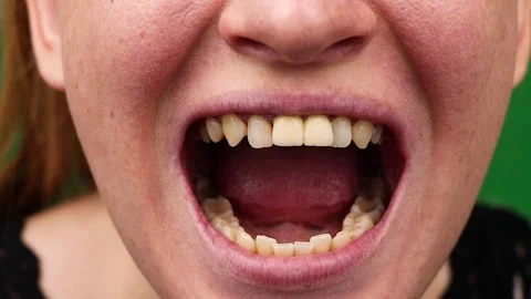 Macro video of yellow teeth. A close-up of a tooth, struck by caries. The concep 스톡 동영상 94830144