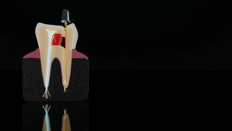 Macro view of anatomical tooth cross section with dental file and nerve branches Stock Illustration