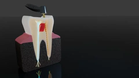 Macro view of distal root canal cleaned by endodontic file in tooth cross Stock Illustration