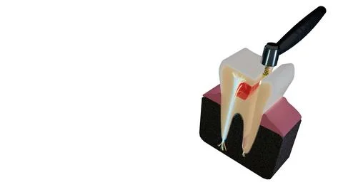 Macro view of human molar cross section showing root canal therapy and Stock Illustration