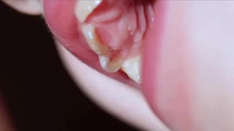 Macro View of the Incisor of a 6-year-old with Pulpitis or Pink Tooth of Mummery Stock Footage 289241718